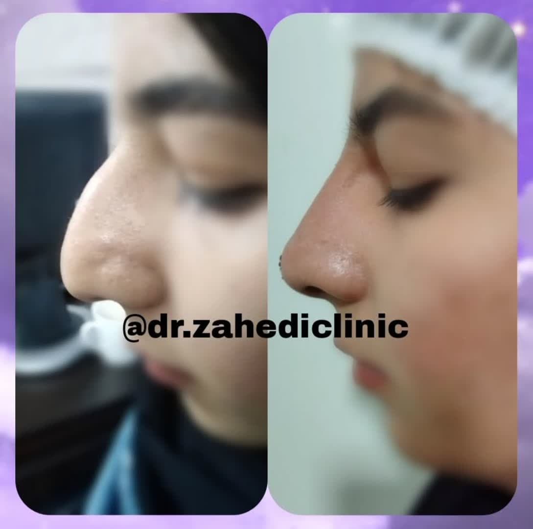 اصلاح فرم بینی