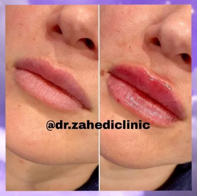 تزریق ژل و بوتاکس