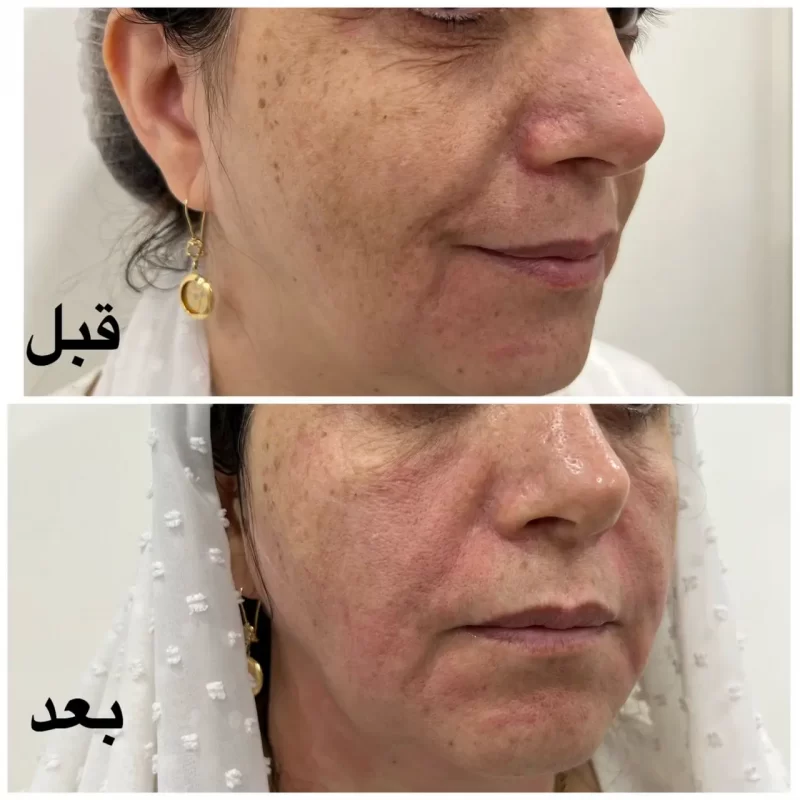 هایفوتراپی