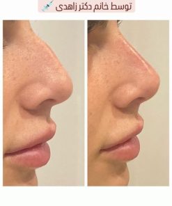 تزریق ژل (1 سی سی)