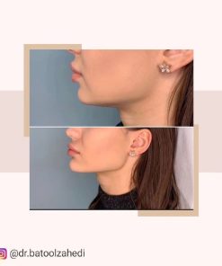 نمونه کار زاویه سازی صورت با تزریق ژل