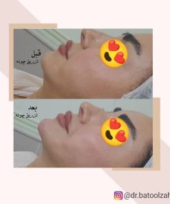 نمونه کار زاویه سازی صورت با تزریق ژل