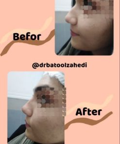 نمونه کار اصلاح فرم بینی