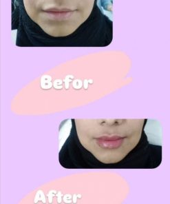 نمونه کار تزریق ژل لب دکتر بتول زاهدی