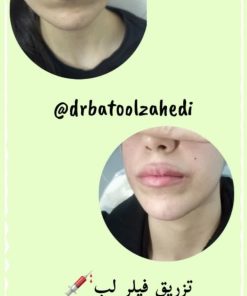 تزریق ژل (1 سی سی)