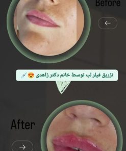 تزریق ژل (1 سی سی)