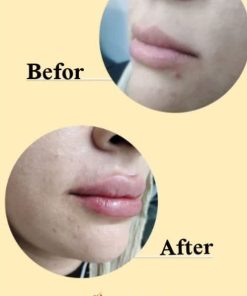 تزریق ژل (1 سی سی)