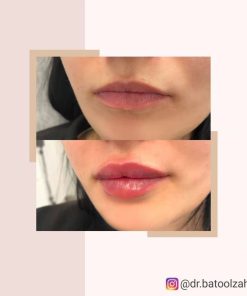 تزریق ژل (1 سی سی)