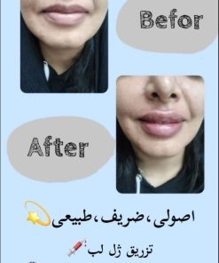 تزریق ژل (1 سی سی)