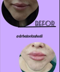 نمونه کار تزریق ژل لب دکتر بتول زاهدی