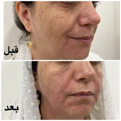 هایفوتراپی